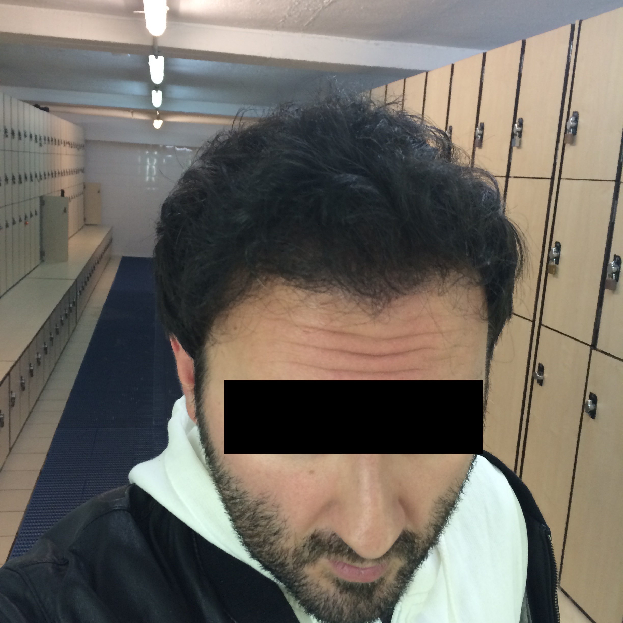 11 meses después del trasplante capilar