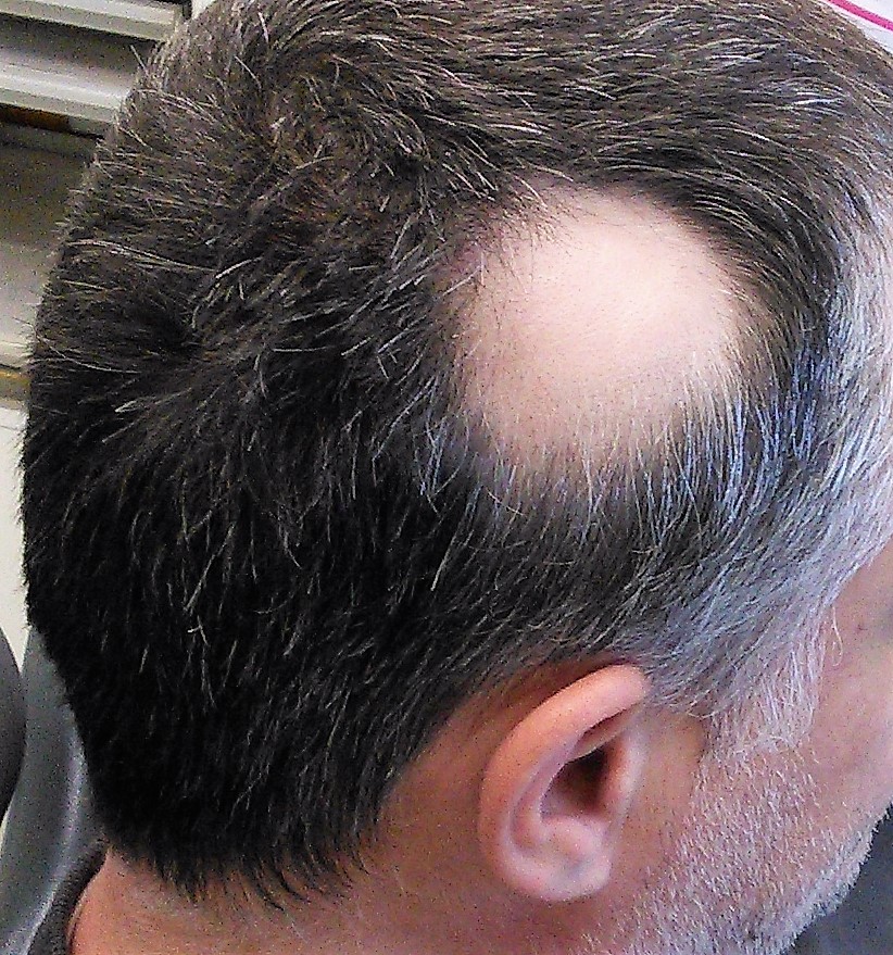La alopecia areata: causas y tratamiento